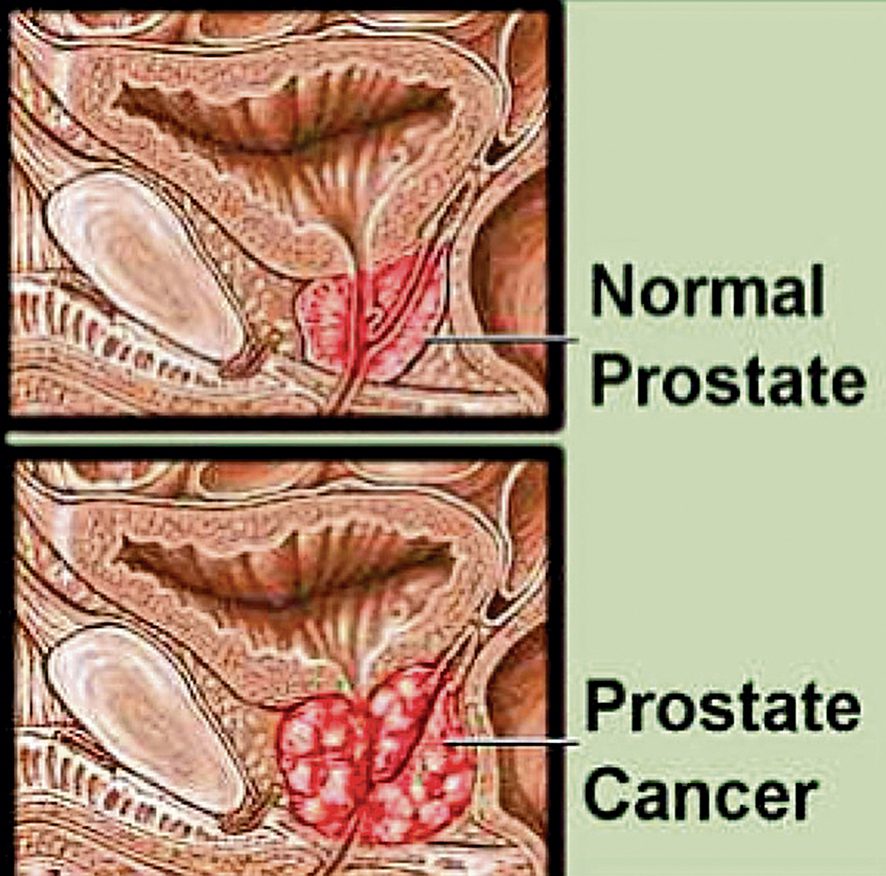 Prostate cancer