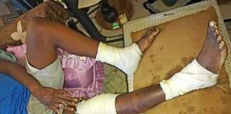 physiotherapy